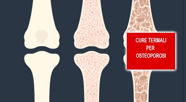 Cure termali per osteoporosi