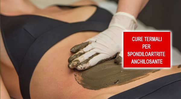 Cure termali per spondiloartrite anchilosante